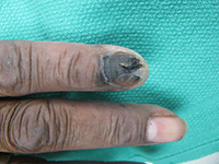 Acral lentiginous melanoma